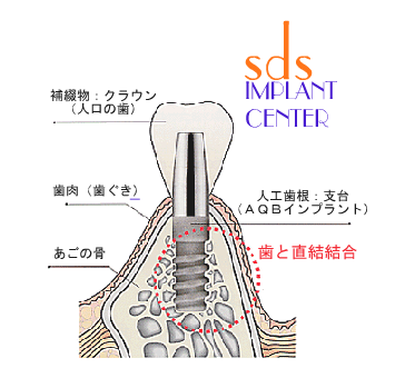 implant_001