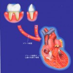 口の細菌が心臓の病気に関係しますの詳細へ